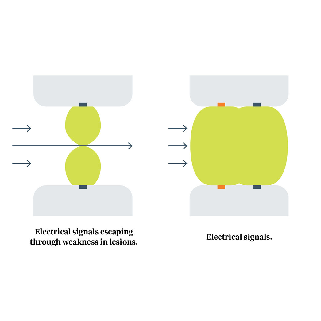 AtriCure Isolator Synergy AtriCure Isolator Synergy