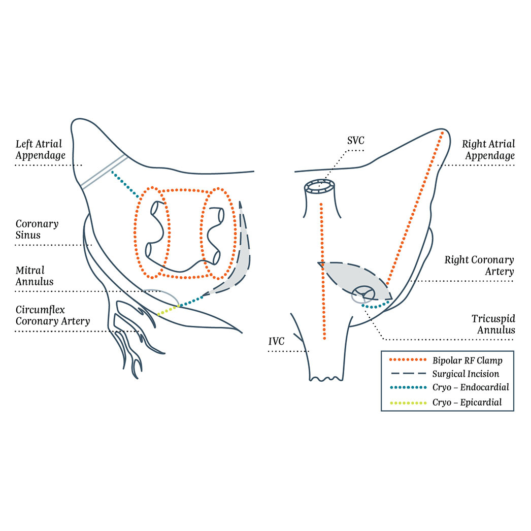 AtriCure Isolator Synergy AtriCure Isolator Synergy